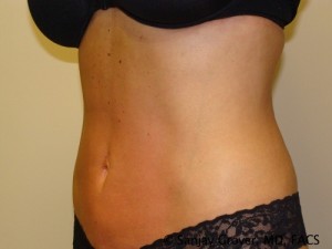 Liposuction Before and After 11 | Grover Aesthetics