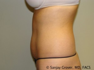 Liposuction Before and After 11 | Sanjay Grover MD FACS