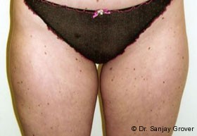 Liposuction Before and After 57 | Sanjay Grover MD FACS