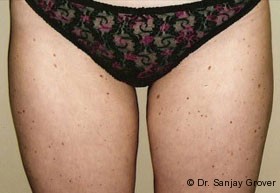 Liposuction Before and After | Grover Aesthetics