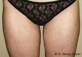 Liposuction Before and After 12 | Sanjay Grover MD FACS