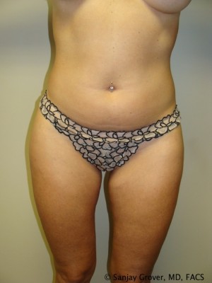 Liposuction Before and After | Grover Aesthetics