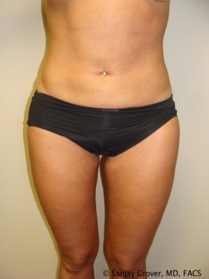 Liposuction Before and After 13 | Sanjay Grover MD FACS