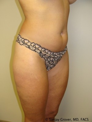 Liposuction Before and After 13 | Grover Aesthetics