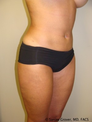 Liposuction Before and After 13 | Grover Aesthetics