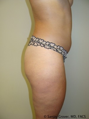Liposuction Before and After 13 | Grover Aesthetics