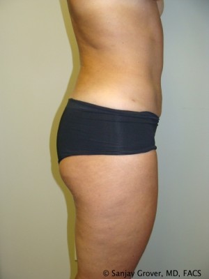 Liposuction Before and After 13 | Grover Aesthetics