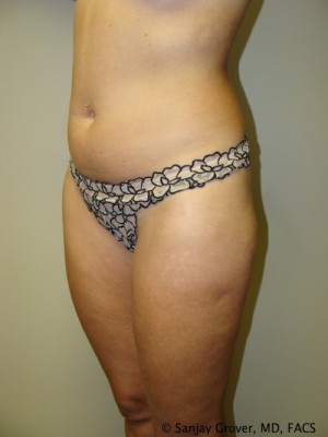 Liposuction Before and After 13 | Grover Aesthetics