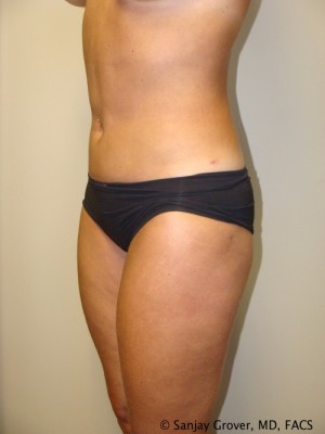 Liposuction Before and After 13 | Grover Aesthetics