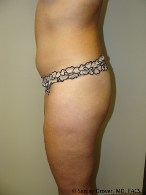 Liposuction Before and After 13 | Grover Aesthetics