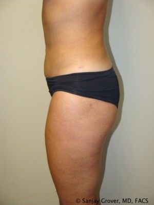 Liposuction Before and After 13 | Grover Aesthetics