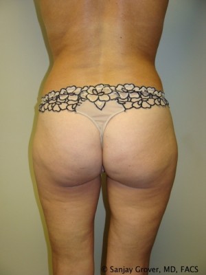 Liposuction Before and After 13 | Grover Aesthetics