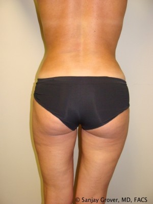 Liposuction Before and After 13 | Grover Aesthetics