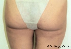 Liposuction Before and After 24 | Sanjay Grover MD FACS