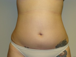 Liposuction Before and After | Grover Aesthetics