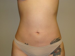 Liposuction Before and After | Grover Aesthetics