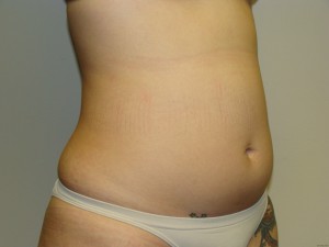 Liposuction Before and After 15 | Sanjay Grover MD FACS
