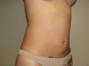 Liposuction Before and After 15 | Grover Aesthetics