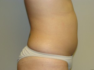 Liposuction Before and After 15 | Grover Aesthetics