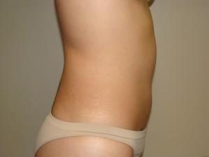 Liposuction Before and After 15 | Grover Aesthetics