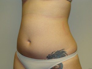 Liposuction Before and After 15 | Grover Aesthetics