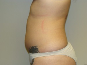 Liposuction Before and After 15 | Grover Aesthetics
