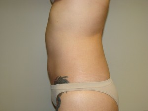 Liposuction Before and After 15 | Grover Aesthetics