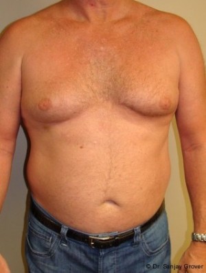 Liposuction Before and After 29 | Sanjay Grover MD FACS