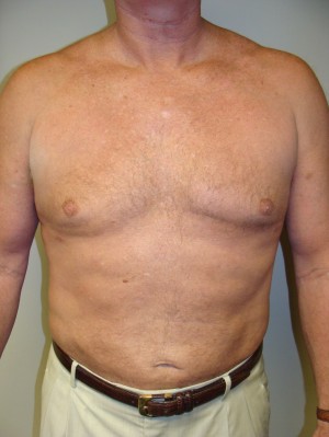 Liposuction Before and After | Grover Aesthetics