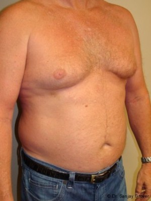 Liposuction Before and After 16 | Sanjay Grover MD FACS