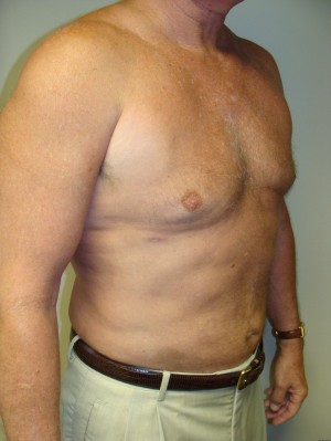 Liposuction Before and After 16 | Grover Aesthetics