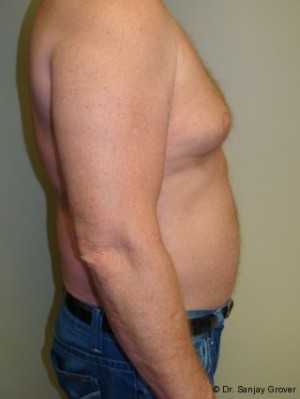Liposuction Before and After 16 | Grover Aesthetics