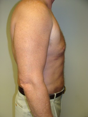 Liposuction Before and After 16 | Grover Aesthetics