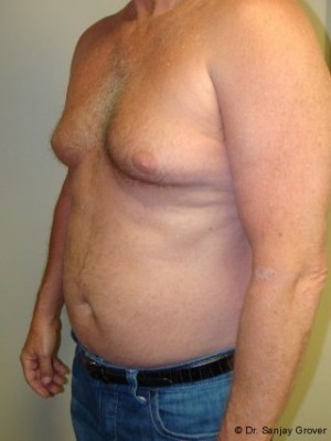 Liposuction Before and After 16 | Grover Aesthetics