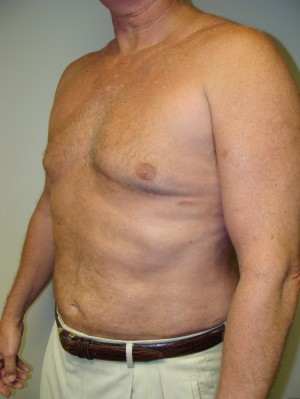 Liposuction Before and After 16 | Sanjay Grover MD FACS