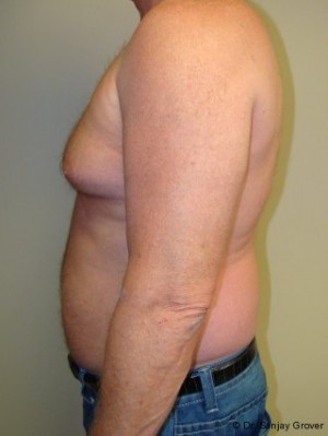 Liposuction Before and After 16 | Grover Aesthetics