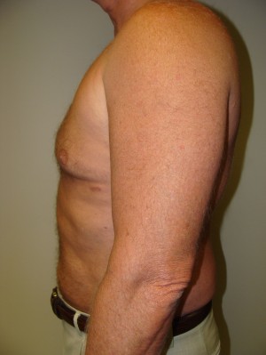 Liposuction Before and After 16 | Grover Aesthetics