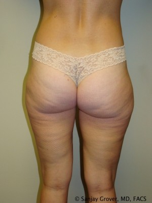 Liposuction Before and After | Grover Aesthetics