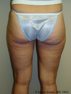 Liposuction Before and After | Grover Aesthetics