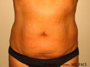 Liposuction Before and After | Grover Aesthetics