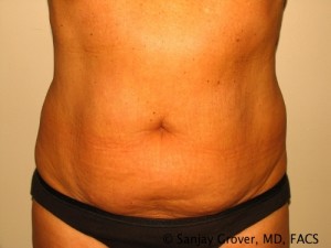 Liposuction Before and After | Sanjay Grover MD FACS