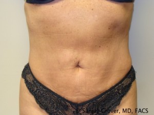 Liposuction Before and After | Sanjay Grover MD FACS