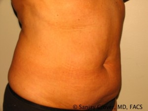 Liposuction Before and After 18 | Grover Aesthetics