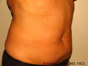 Liposuction Before and After 18 | Sanjay Grover MD FACS