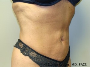 Liposuction Before and After 18 | Sanjay Grover MD FACS