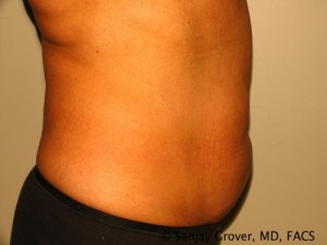 Liposuction Before and After 18 | Sanjay Grover MD FACS