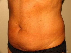 Liposuction Before and After 18 | Sanjay Grover MD FACS