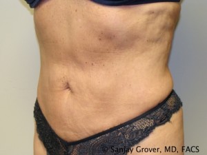 Liposuction Before and After 18 | Sanjay Grover MD FACS