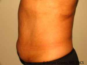 Liposuction Before and After 18 | Grover Aesthetics