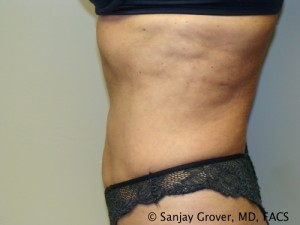 Liposuction Before and After 18 | Sanjay Grover MD FACS